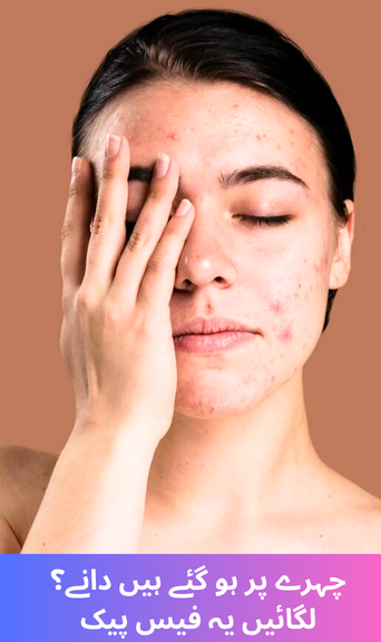 Got acne on your face? Try these face packs!
